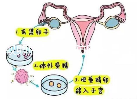 取卵后怎么預(yù)防卵巢囊腫?5種科學(xué)方法值得學(xué)習(xí)