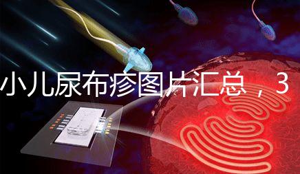 小兒尿布疹圖片匯總，3種類型癥狀大不一樣